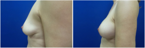 IP-breast-lift-mastopexy-revision-before-after-1-2