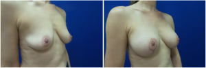 IP-breast-lift-mastopexy-revision-before-after-1-4