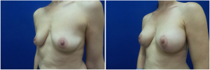 IP-breast-lift-mastopexy-revision-before-after-1-5