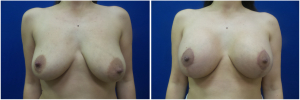 KN-breast-lift-mastopexy-revision-before-after-1-1