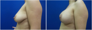 KN-breast-lift-mastopexy-revision-before-after-1-2