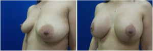 KN-breast-lift-mastopexy-revision-before-after-1-3