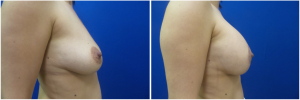 KN-breast-lift-mastopexy-revision-before-after-1-5