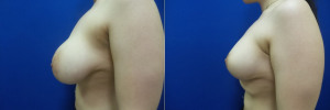 NT-breast-implants-augmentation-mastopexy-revision-before-after-1-2