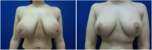 NT-breast-lift-mastopexy-revision-before-after-1-1