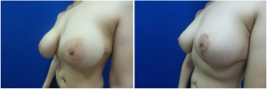 NT-breast-lift-mastopexy-revision-before-after-1-2