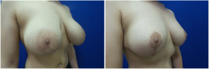 NT-breast-lift-mastopexy-revision-before-after-1-3