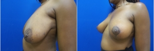 breast-lift-1-2