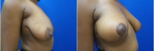 breast-lift-1-3