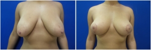 breast-lift-2-1