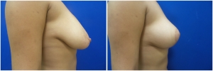 breast-lift-2-2