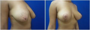 breast-lift-2-3