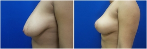 breast-lift-2-4