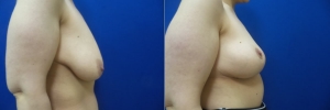 breast-lift-3-2