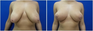 breast-lift-mastopexy-before-after-4-1