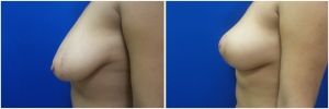 breast-lift-mastopexy-before-after-4-4
