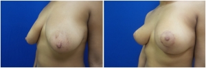 breast-lift-mastopexy-before-after-4-5