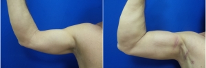 bicep-implants-1