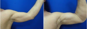 bicep-implants-2