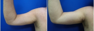 bicep-implants-3-1