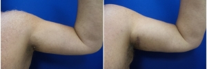bicep-implants-3-2