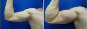 bicep-implants-4-1