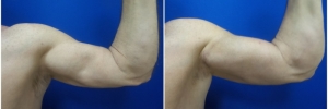 bicep-implants-4-2
