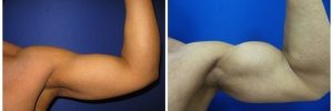 biceps1