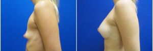 breast-augmentation-12-1