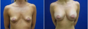 breast-augmentation-12-2