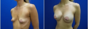 breast-augmentation-12-3