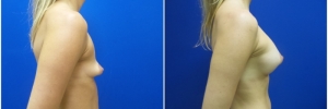 breast-augmentation-12-4
