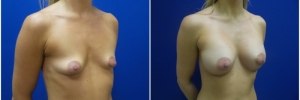 breast-augmentation-12-5