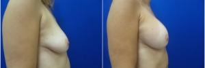 breast-augmentation-14-1