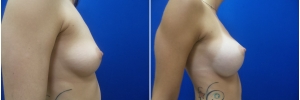 breast-implants-10-1