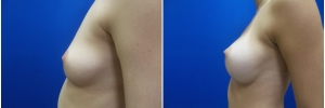 breast-implants-10-3