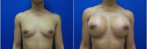 breast-implants-13-1
