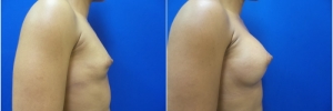 breast-implants-13-2