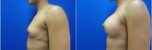breast-implants-13-3