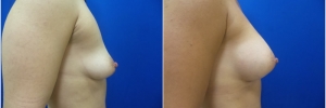 breast-implants-15-2