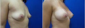 breast-implants-15-3