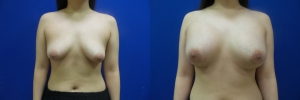 breast-implants-augmentation-17-1