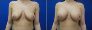 breast-implants-augmentation-18-1