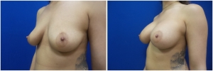 breast-implants-augmentation-18-2
