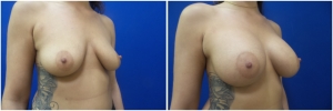 breast-implants-augmentation-18-3