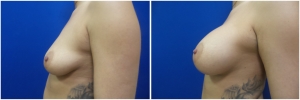 breast-implants-augmentation-18-5
