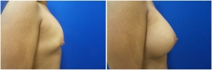 breast-implants-augmentation-19-1