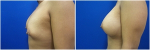 breast-implants-augmentation-19-2
