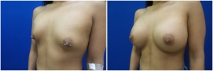 breast-implants-augmentation-19-3