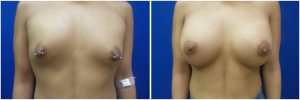 breast-implants-augmentation-19-4